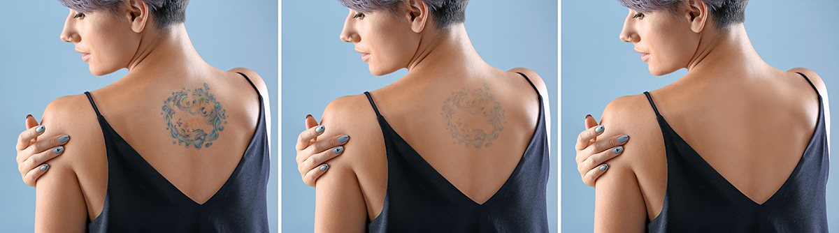 How much does Laser tattoo removal cost - here's your guide.