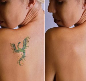 Laser tattoo removal befor and after