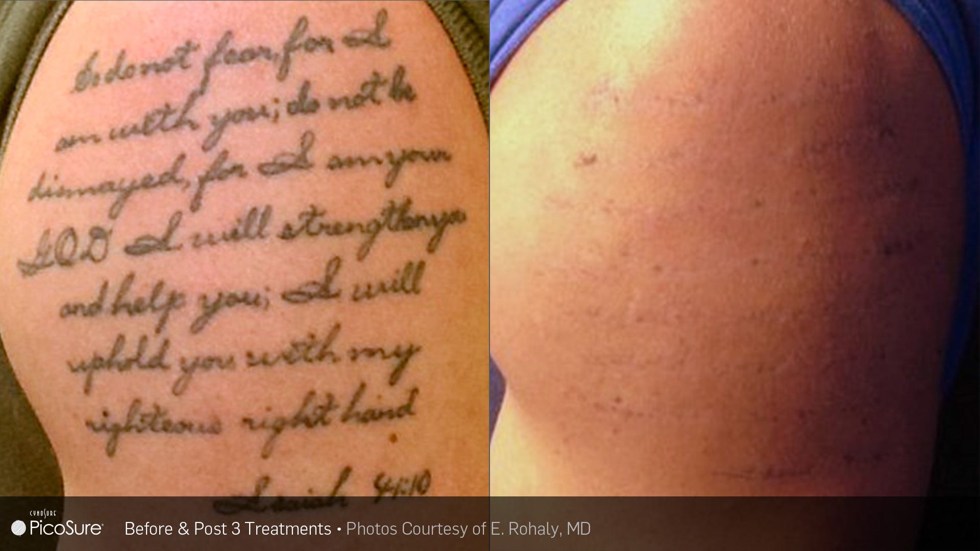 laser tattoo removal before and after compare